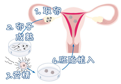 拉拉供卵代孕中心